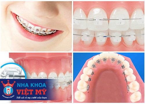chỉnh nha niềng rang tại nha khoa Việt Mỹ