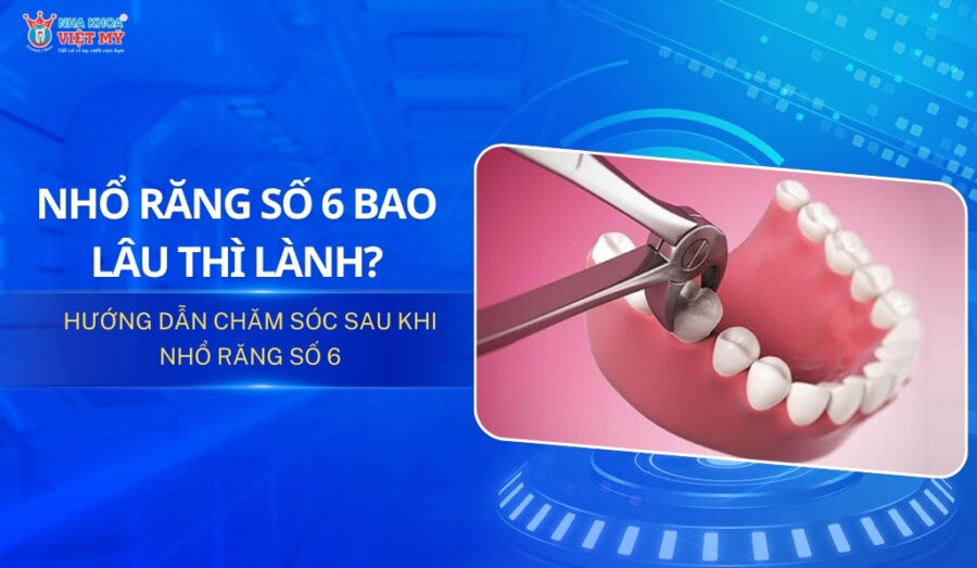 thumbnail nhổ răng số 6 bao lâu thì lành